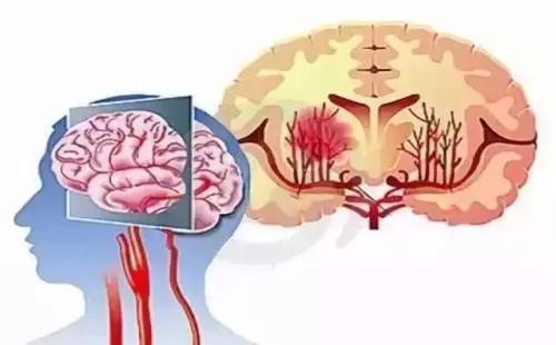 脑血管病好治吗,脑血管中医特色治疗