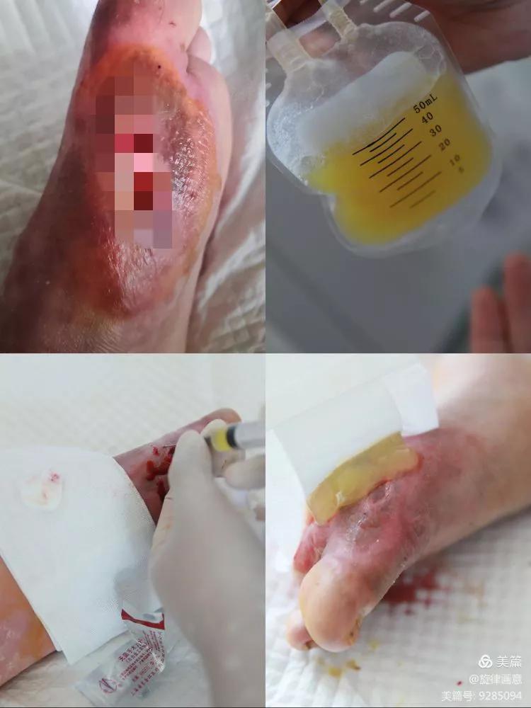 我院输血科完成临汾市首例PRP治疗【技术新突破】