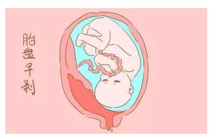 孕妇肚子疼了3小时才上医院，检查发现没了胎心