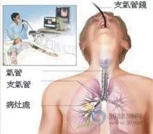 小孩肺炎支气管镜洗肺过程,肺炎总是不好怎么办