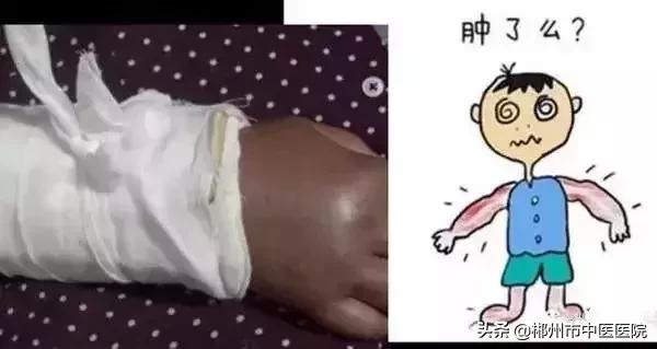 骨折后小夹板固定,骨折小夹板固定方法实操