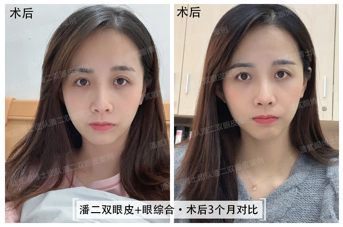 眼综合可以去掉抬头纹吗,眼综合抬头纹