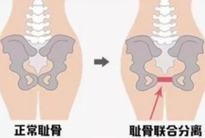 耻骨疼严重的什么程度,耻骨疼有多难受