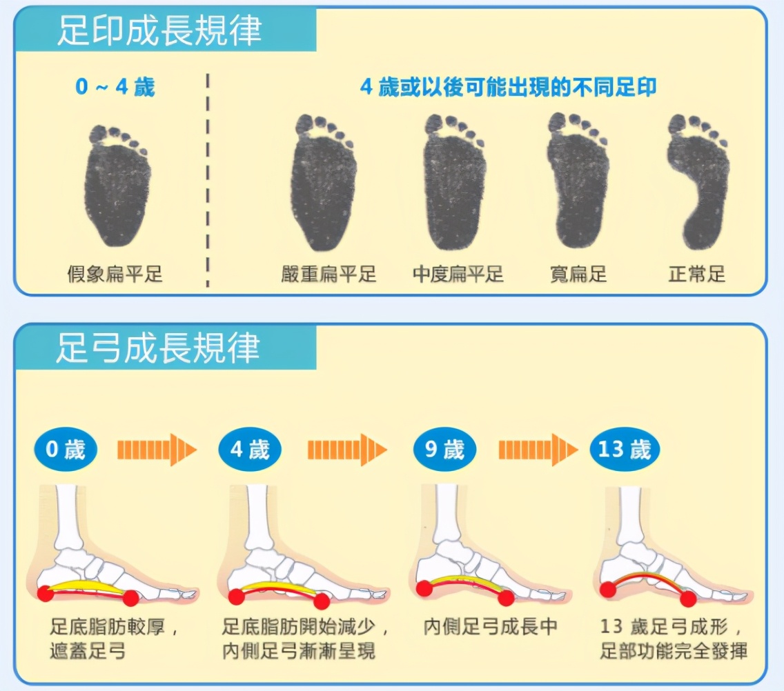儿童足型发育,儿童足外翻x型腿内八字