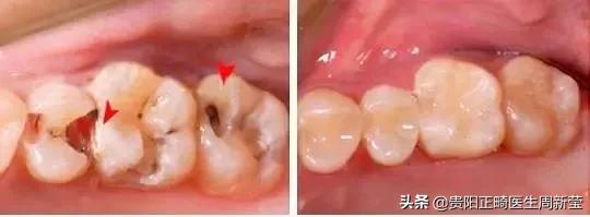 牙疼去看牙需求多久,牙疼的建议