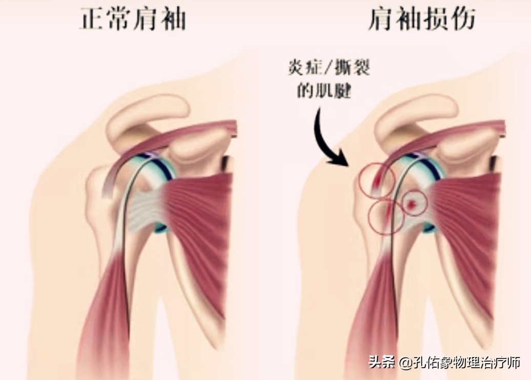 老年人肩周疼痛的厉害怎么治疗,老年人肩背部疼痛怎么回事