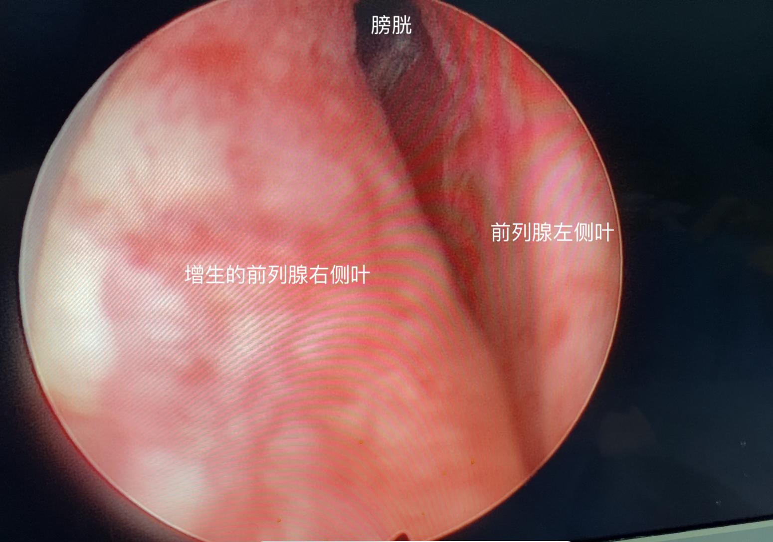 中医治疗前列腺增生什么药最有效,中医治疗前列腺增生多久能见效